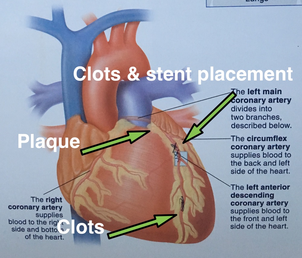 graphic of a heart showing where my plaque, stent, and clots are or were.